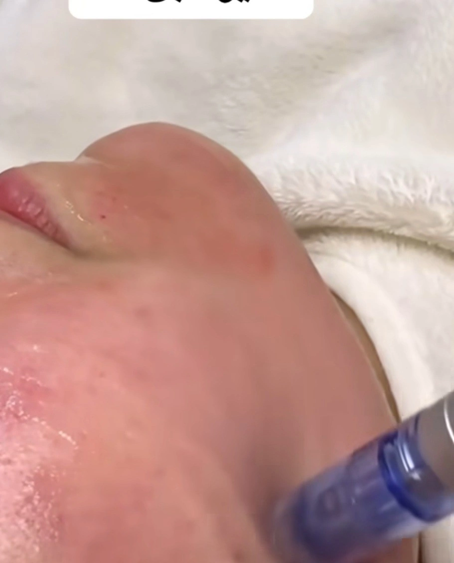 מיקרונידלינג לפנים