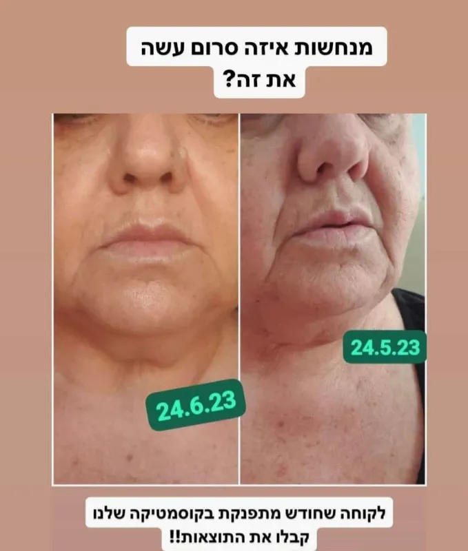 סידרת אינפינטי לעור בוגר ויבש