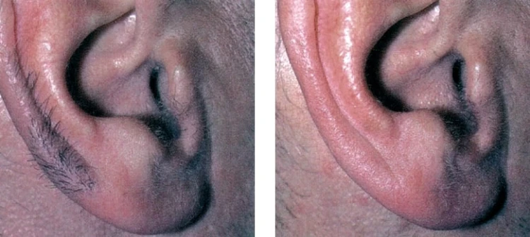 טיפולי לייזר להסרת שיער ללא כאבים