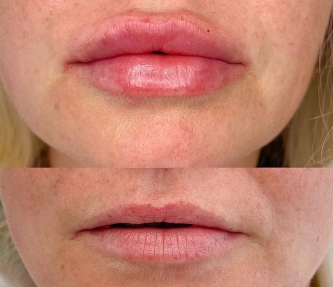 טיפולי אסתטיקה (הזרקות)