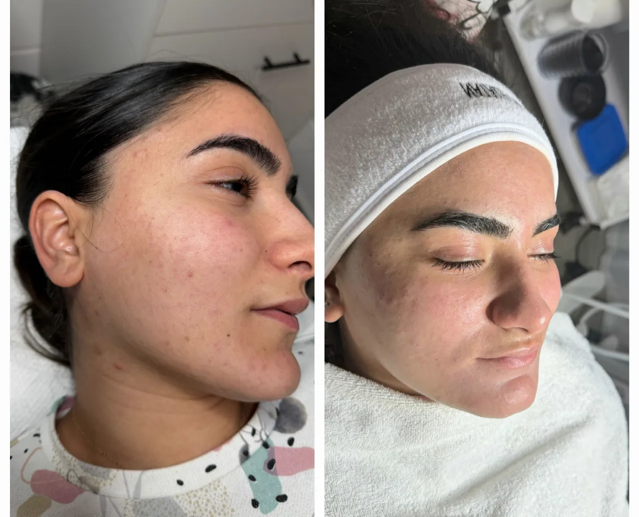 טיפול באקנה 