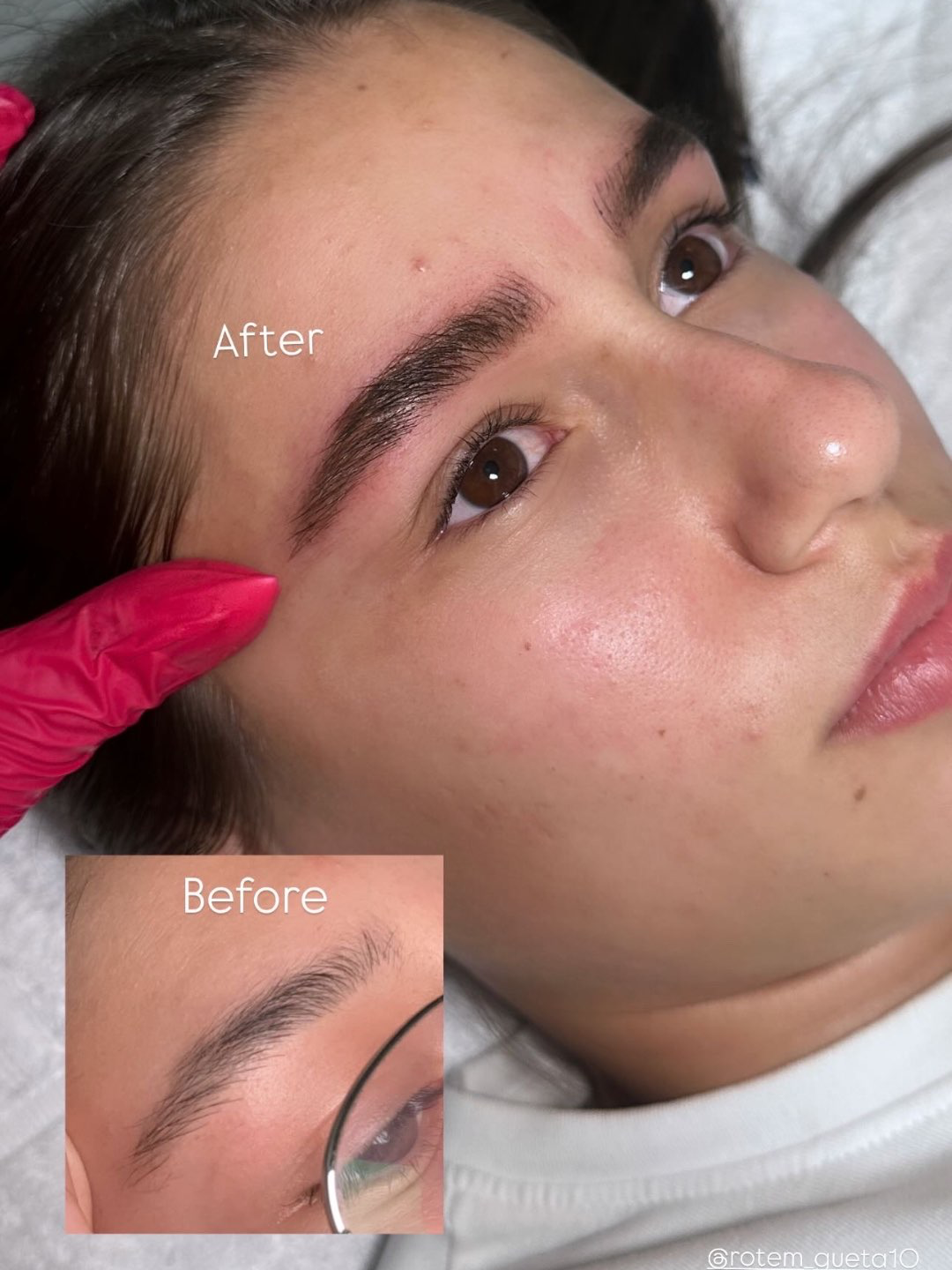 מיקרובליידינג