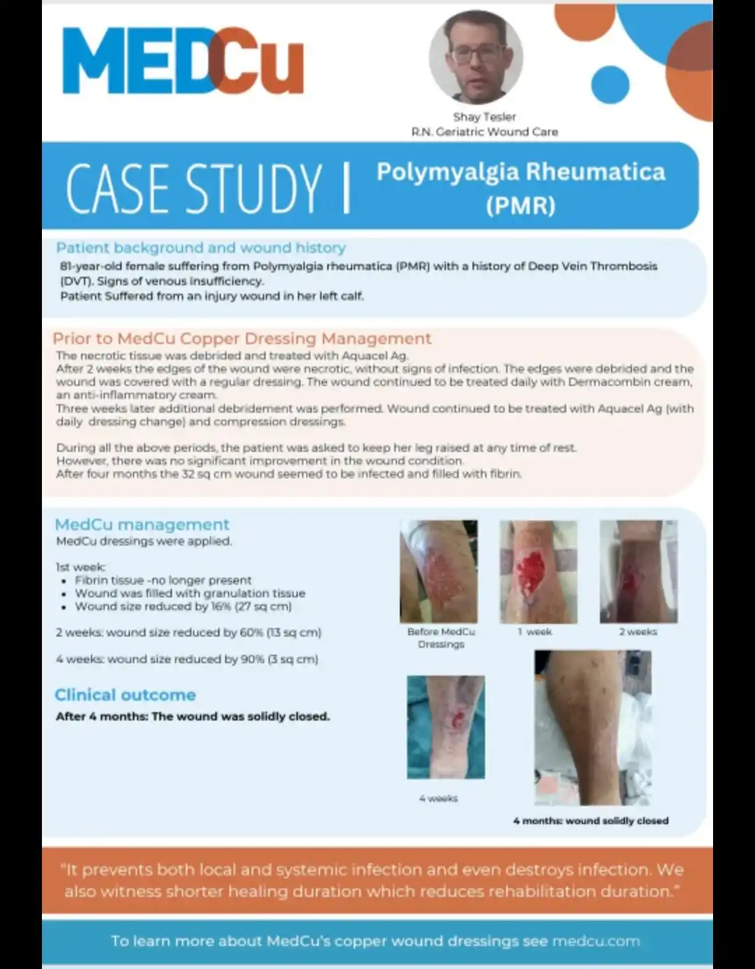 מאמר בנושא טיפול בפצע קשי ריפוי באמצעות חבישת נחושת