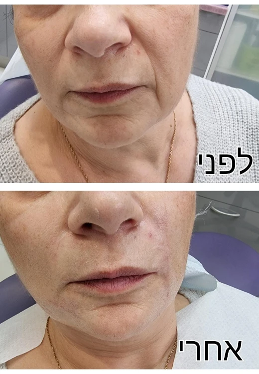 עיצוב שפתיים