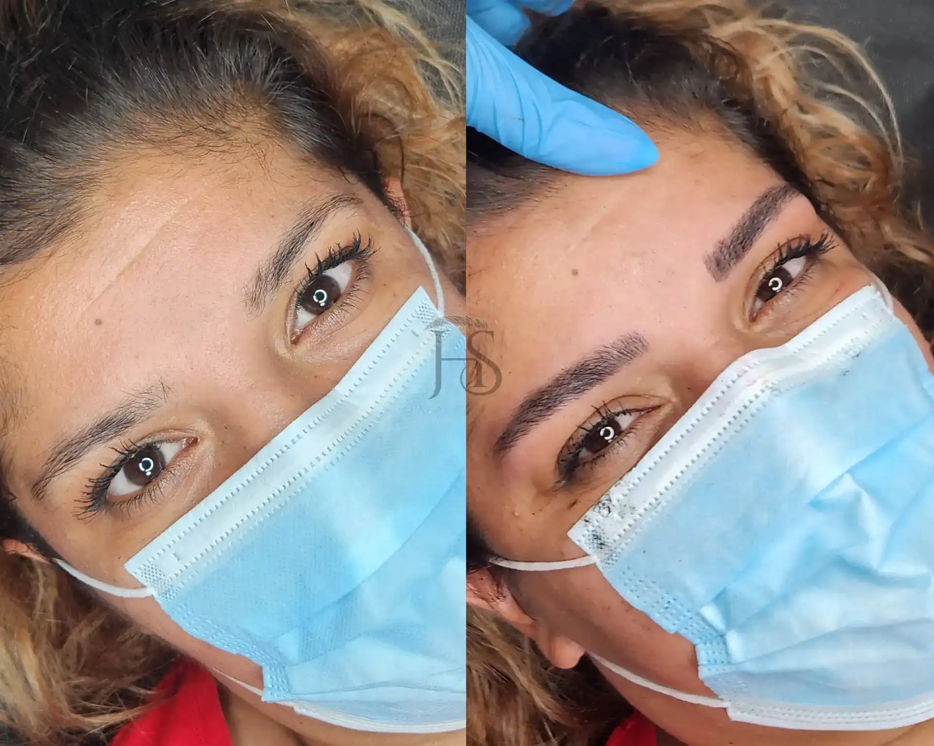 מיקרובליידינג