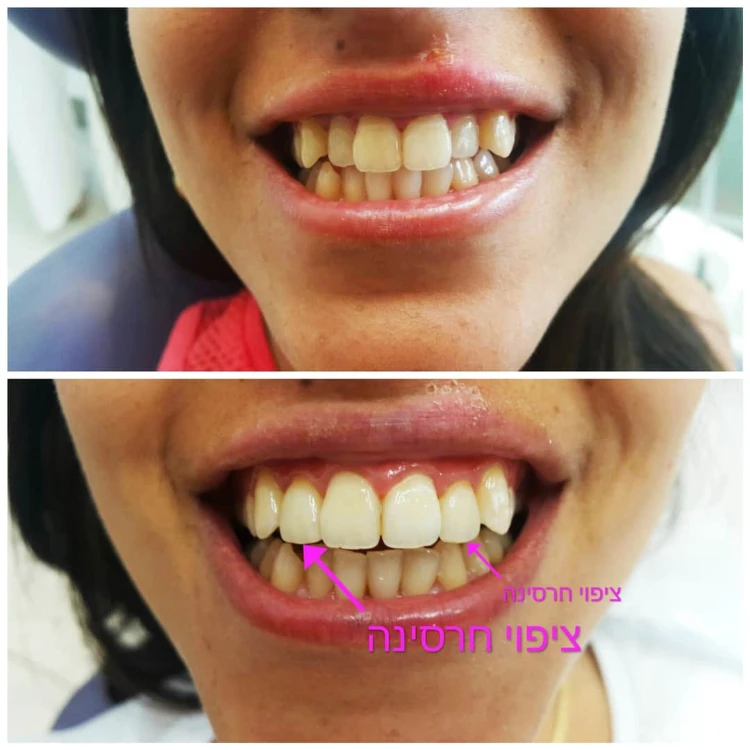 כתרים חרסינה