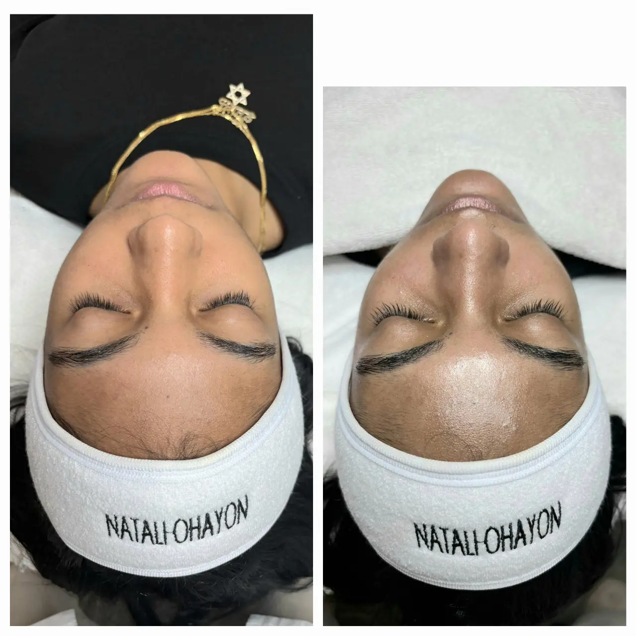 טיפול פנים קלאסי