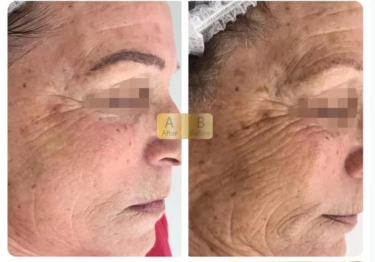 Anti aging treatment - 300$ - 75 min