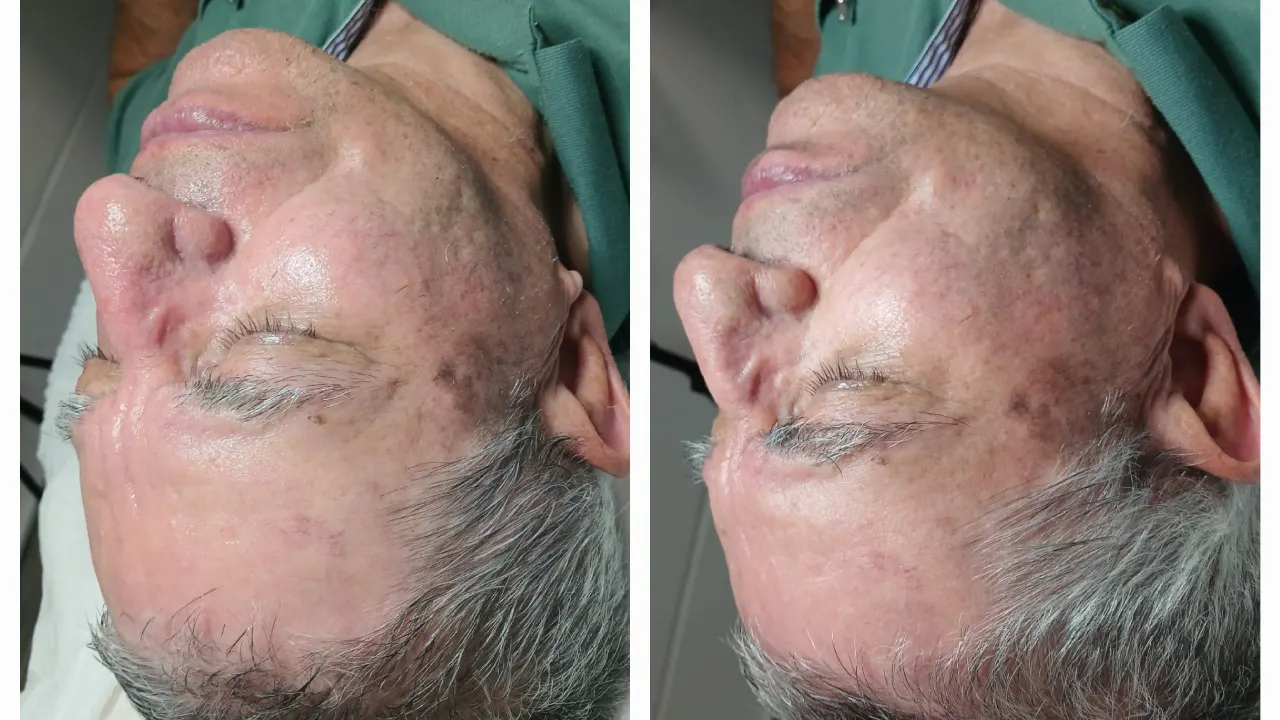 טיפול אייגינג  ומיצוק העור בשיטת RF