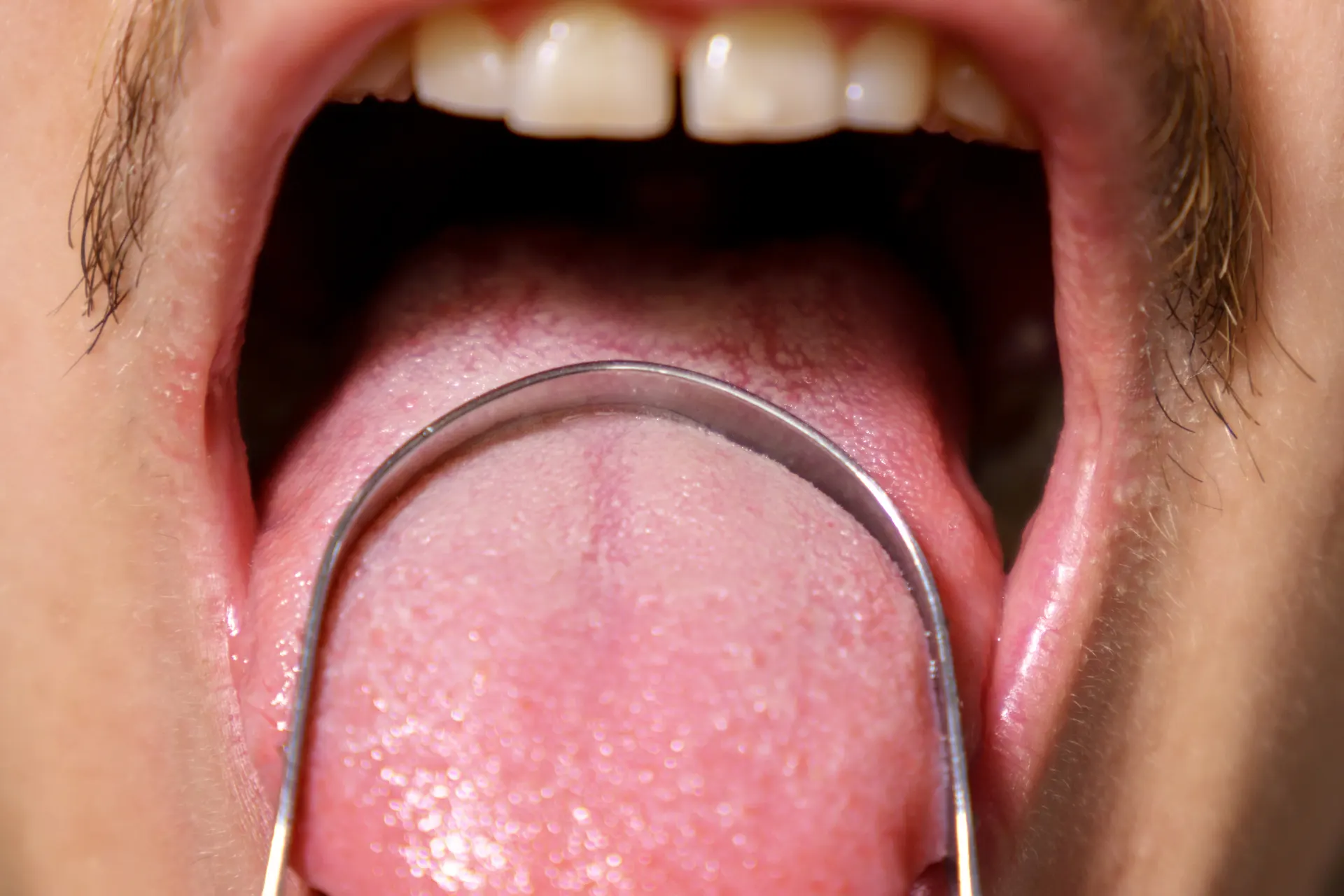 איך לטפל בקנדידה בצורה טבעית ויעילה?