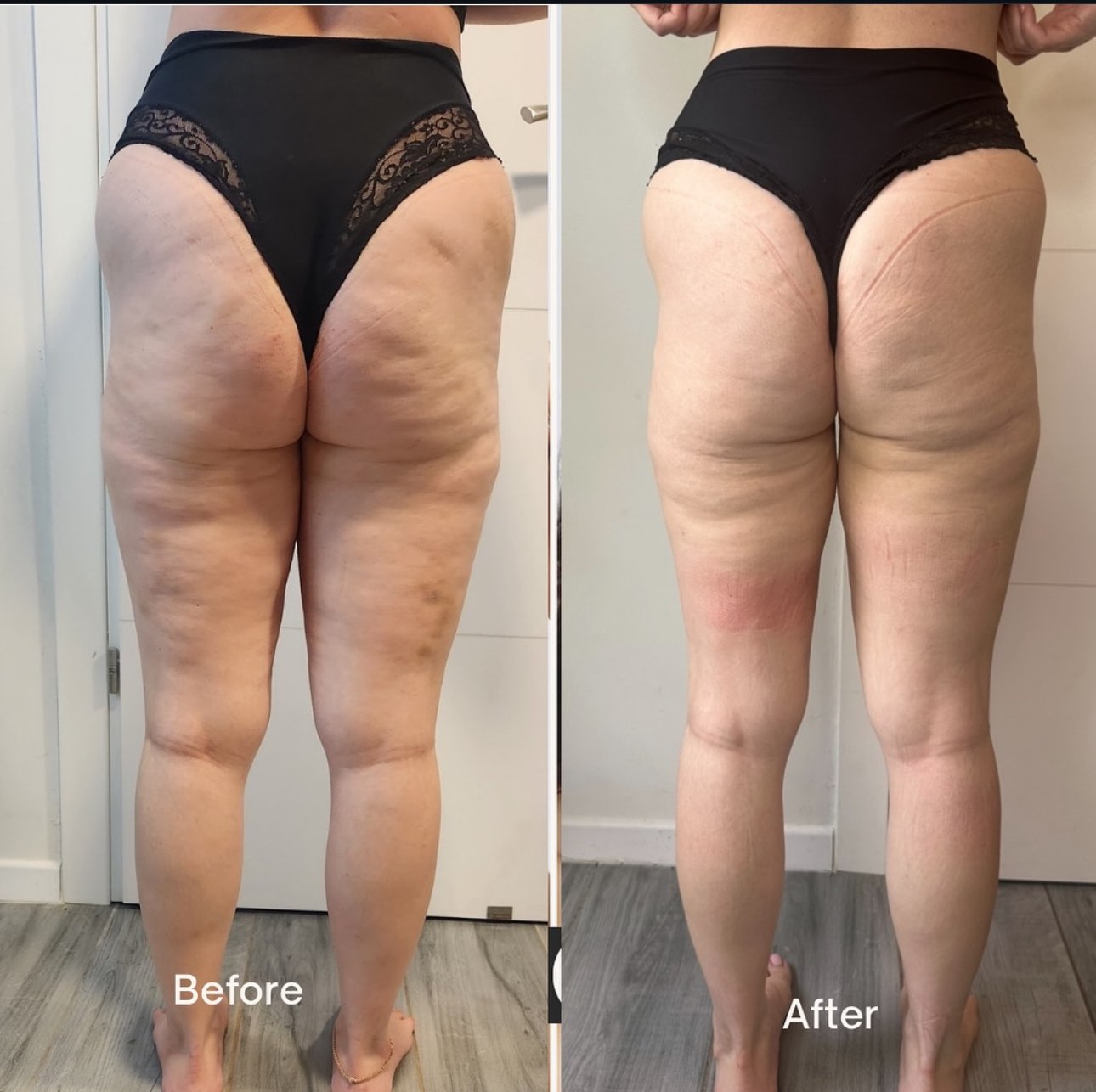 טיפולי גוף משולב - פרסותרפיה וואקום 