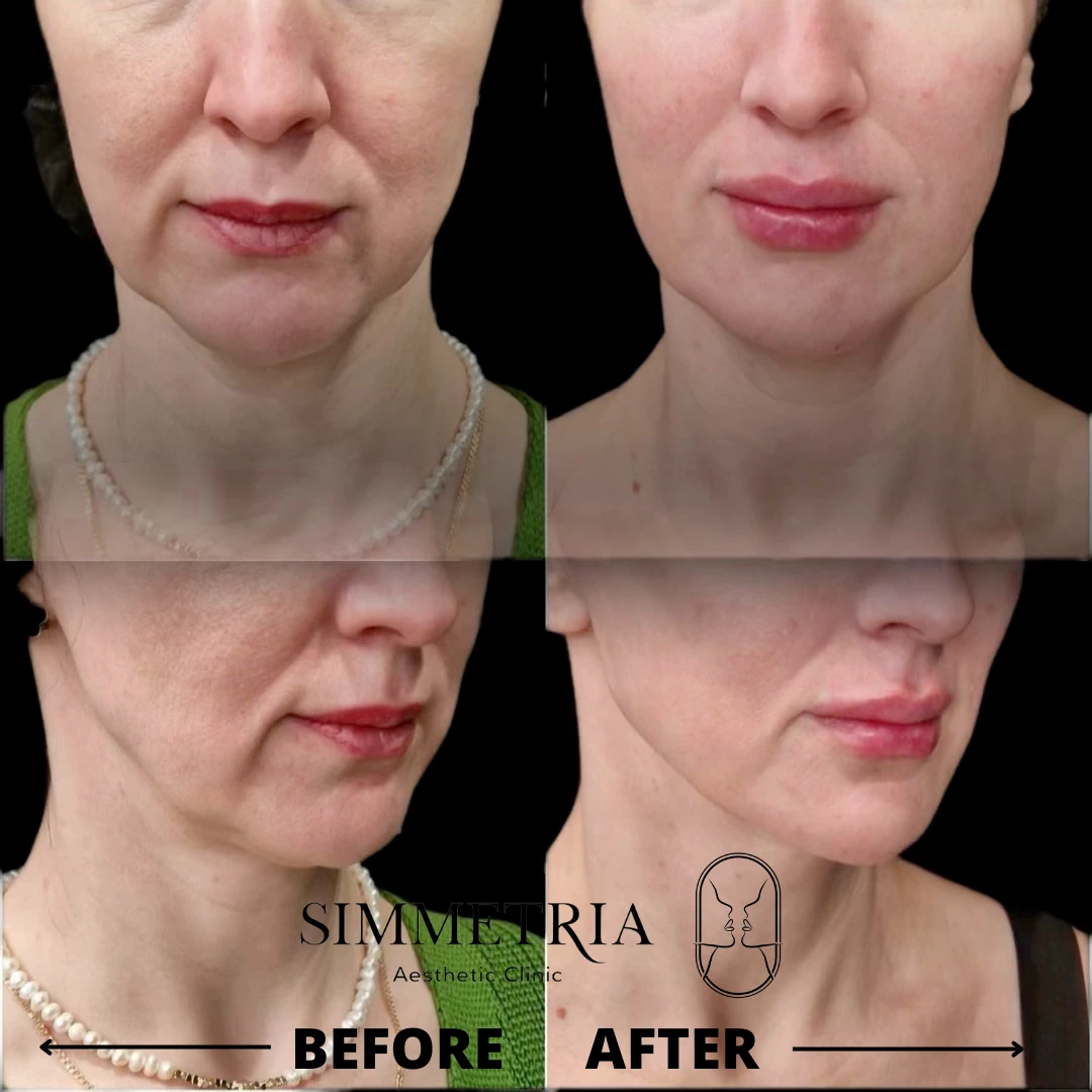 מילוי קמטי נזולביאל/מריונטות