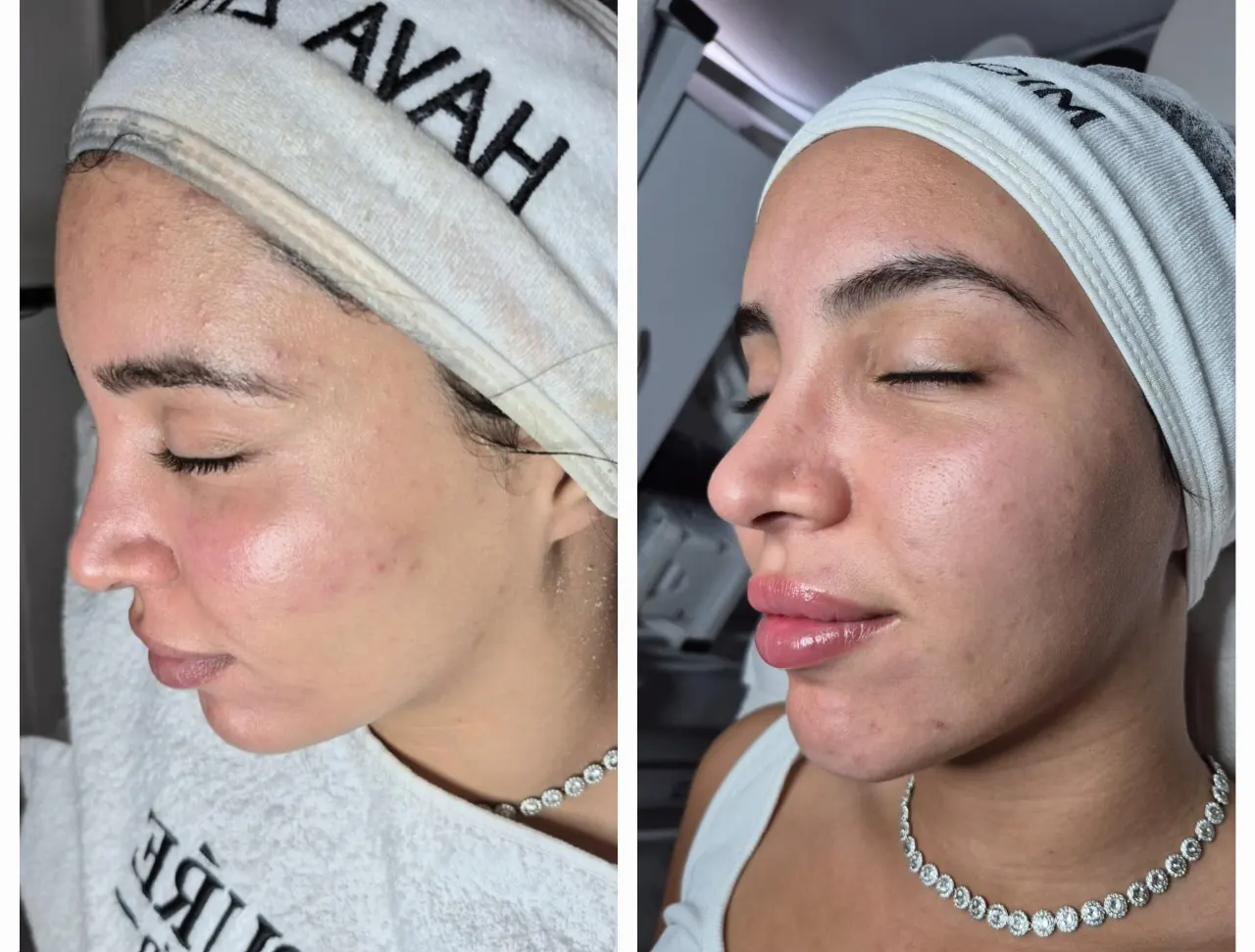  טיפול מיגור דלקת האקנה