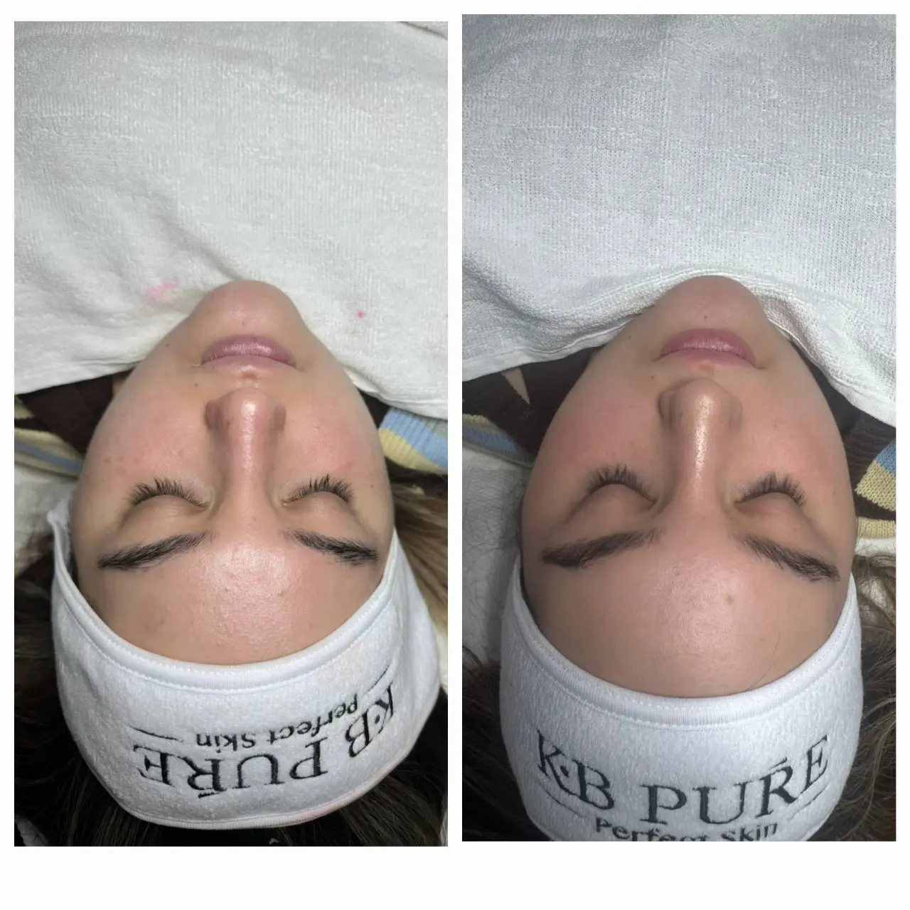 טיפול פנים קלאסי