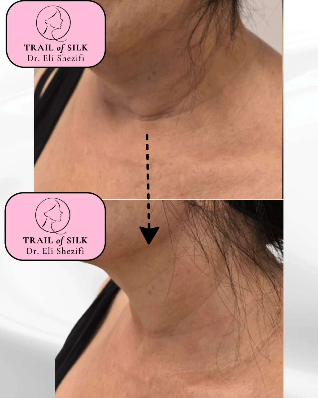 שיפור מרקם העור