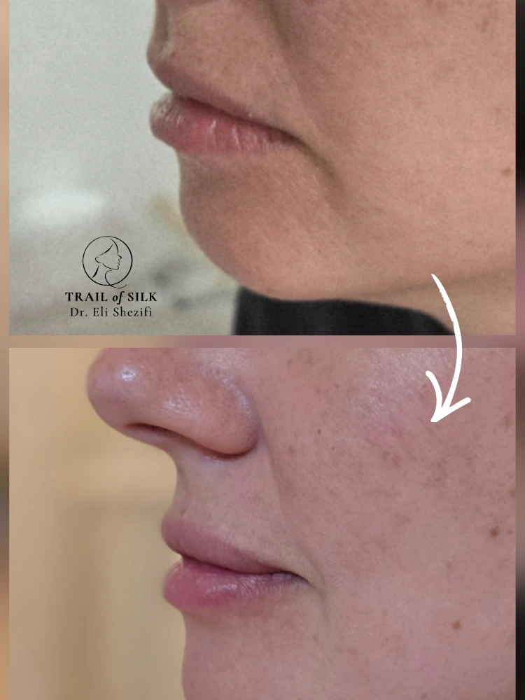 מילוי שפתיים