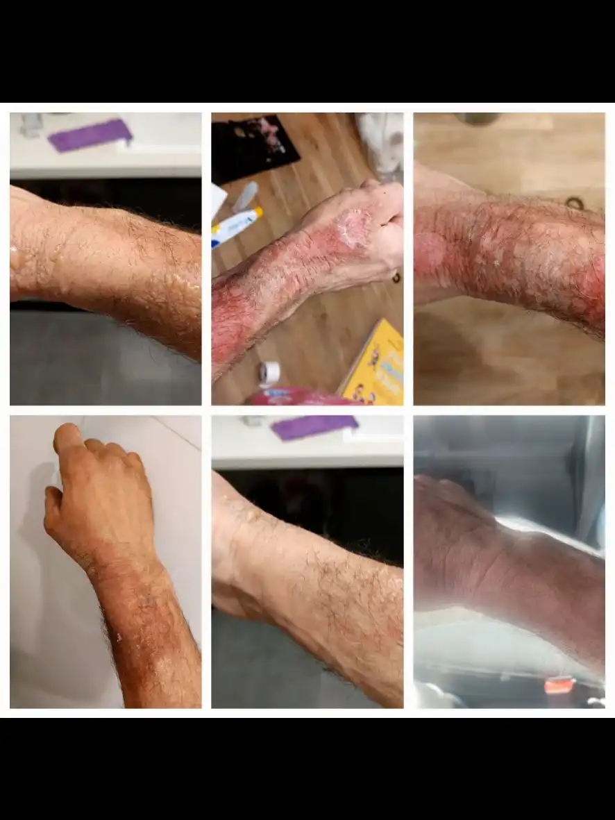 טיפול בכוויה משמן מנוע.