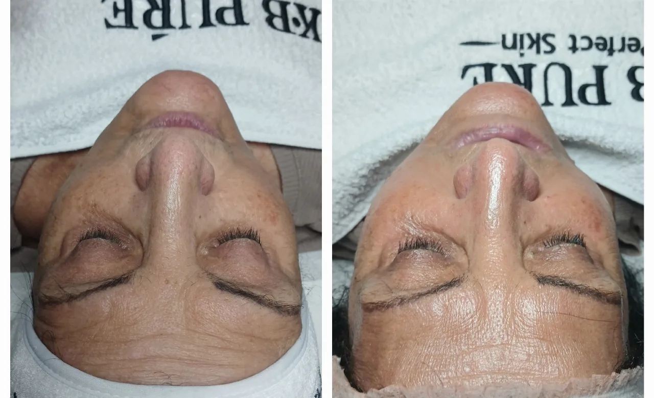 טיפול אייגינג  ומיצוק העור בשיטת RF