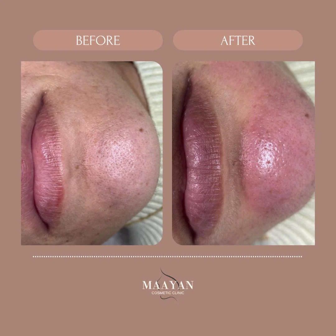 ניקוי הסנטר