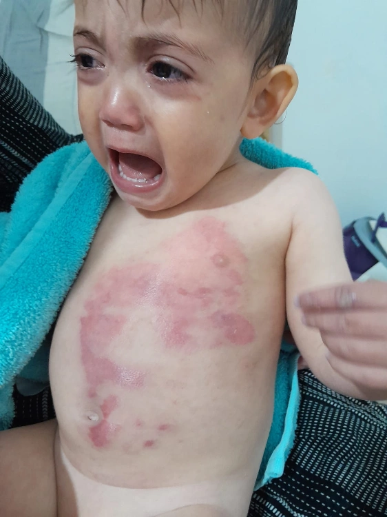 קצב ריפוי בלתי נתפס - כוויה לתינוק שנשפך עליו מים חמים