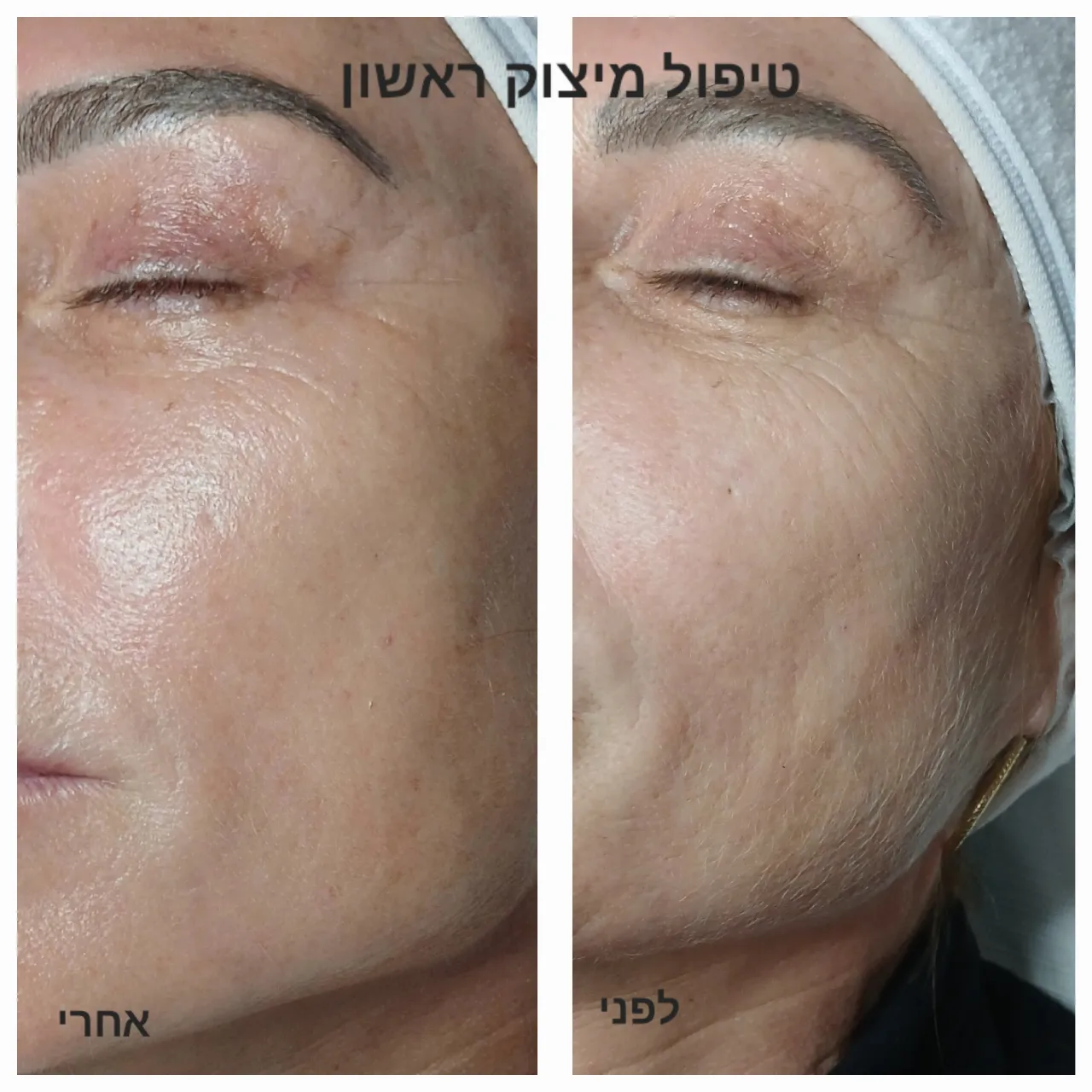 טיפול אייגינג  ומיצוק העור בשיטת RF