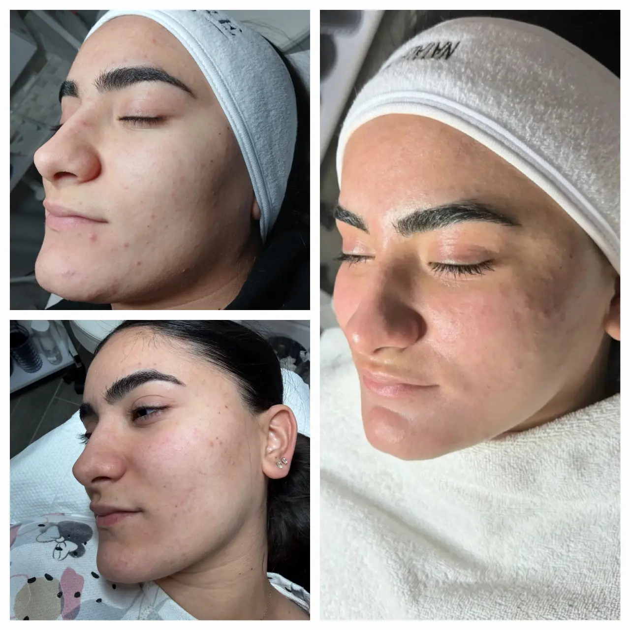 טיפול באקנה 