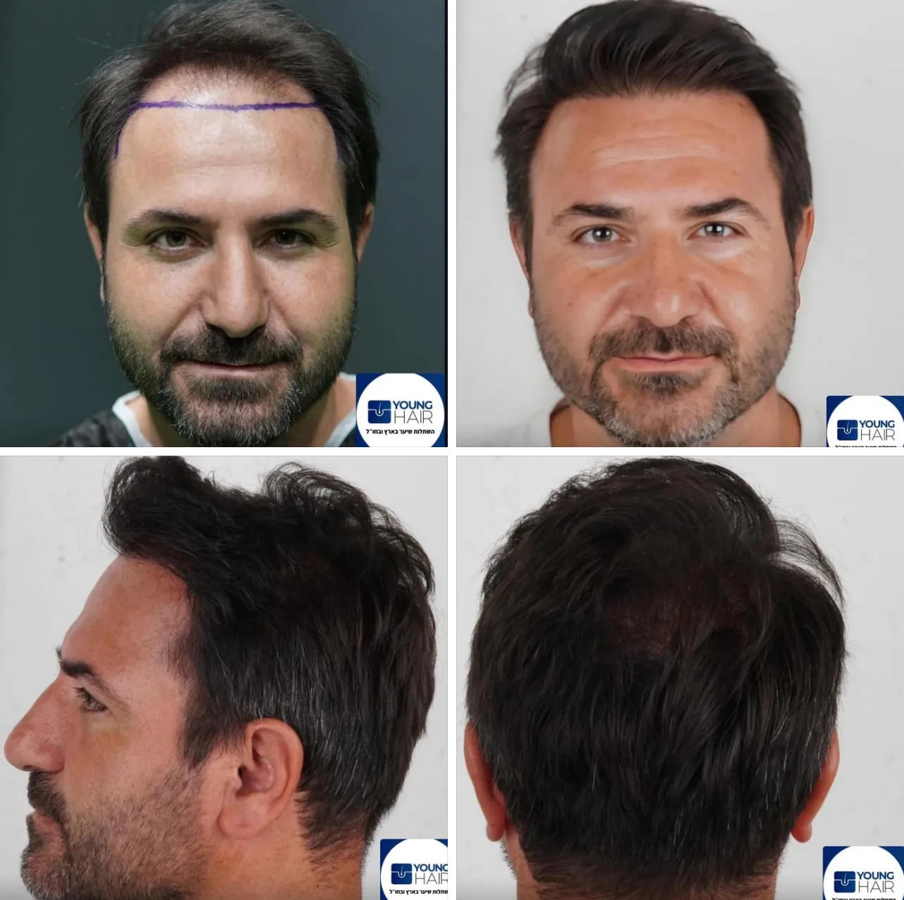 תמונות לפני ואחרי