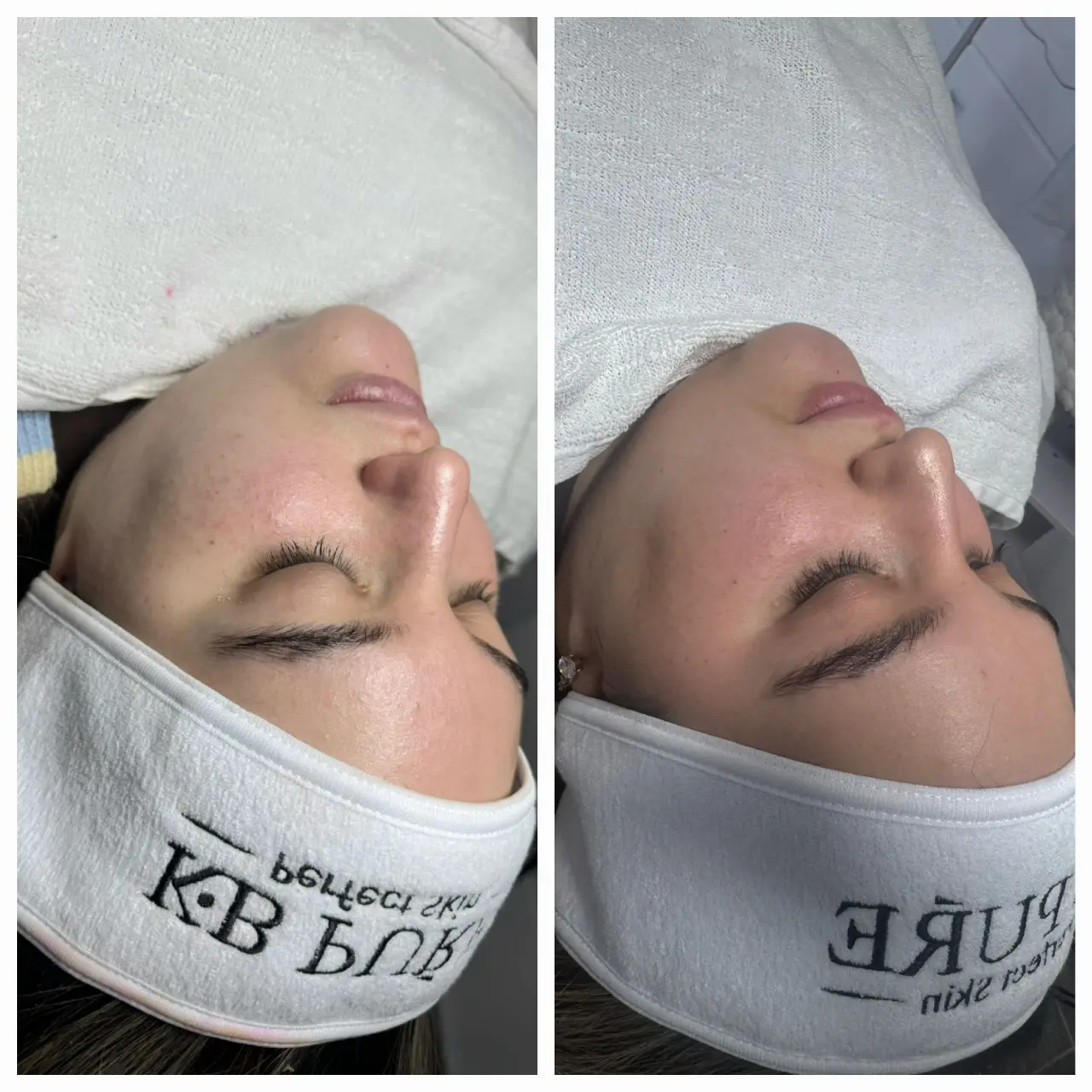 טיפול פנים קלאסי