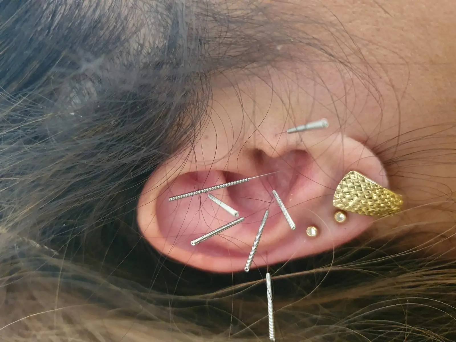 איך דיקור סיני יכול להקל על כאבים כרוניים?