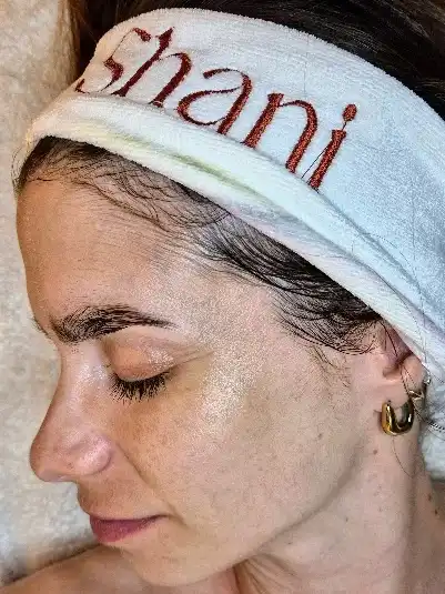 טיפול פנים - הבהרת פיגמנטציה