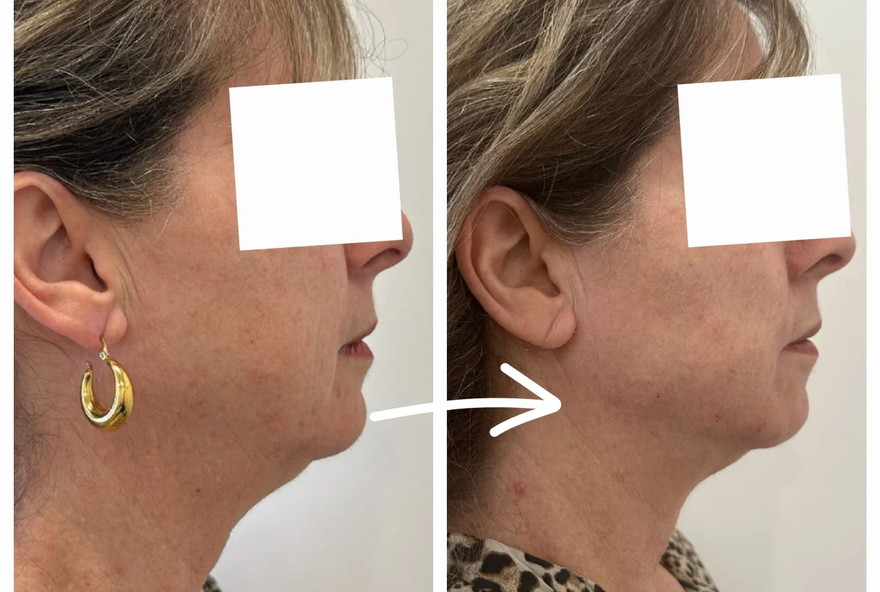 פיסול ועיצוב בחומצה היאלורונית