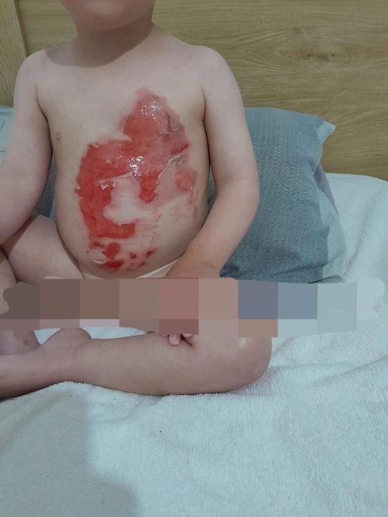 קצב ריפוי בלתי נתפס - כוויה לתינוק שנשפך עליו מים חמים