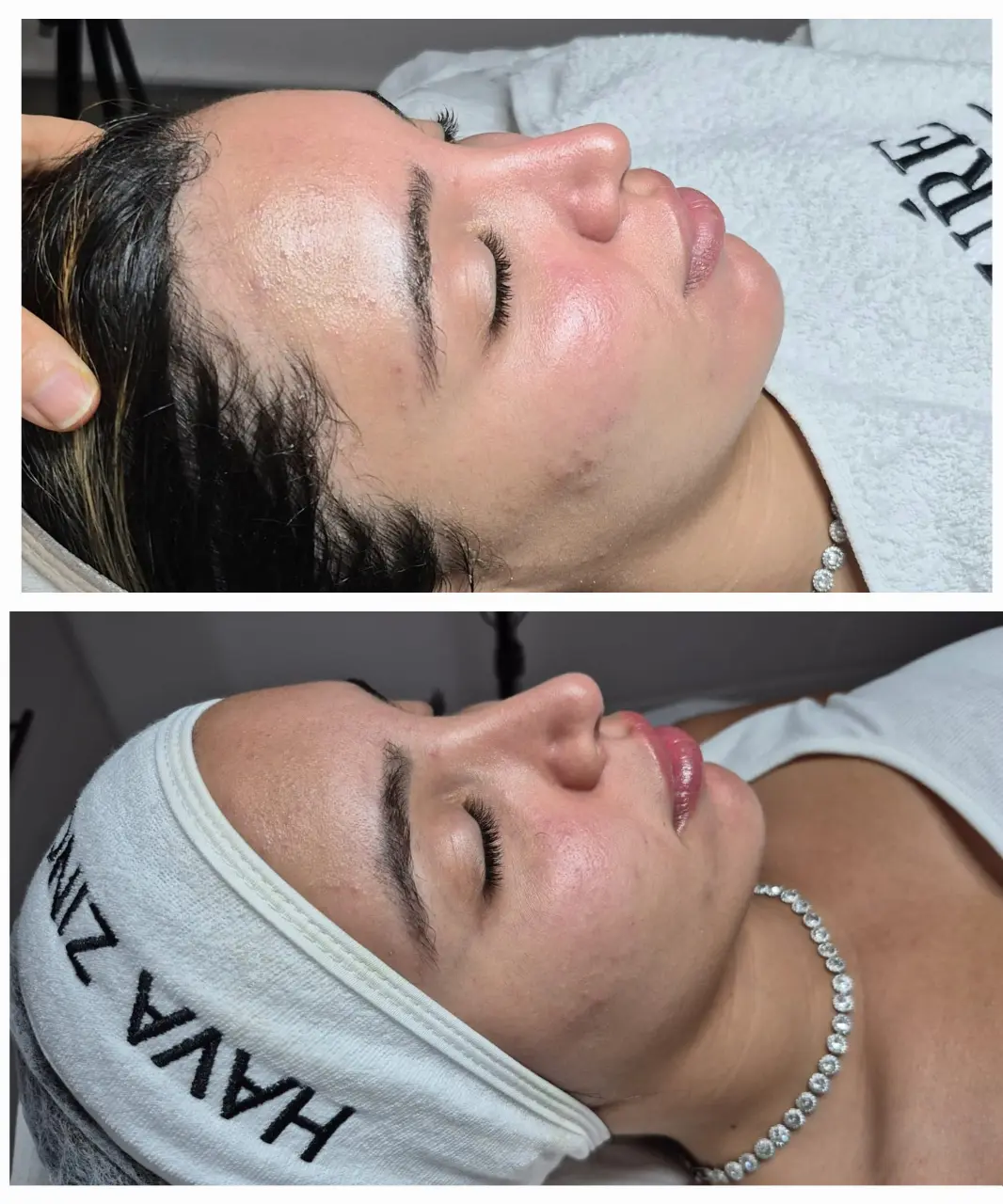  טיפול מיגור דלקת האקנה