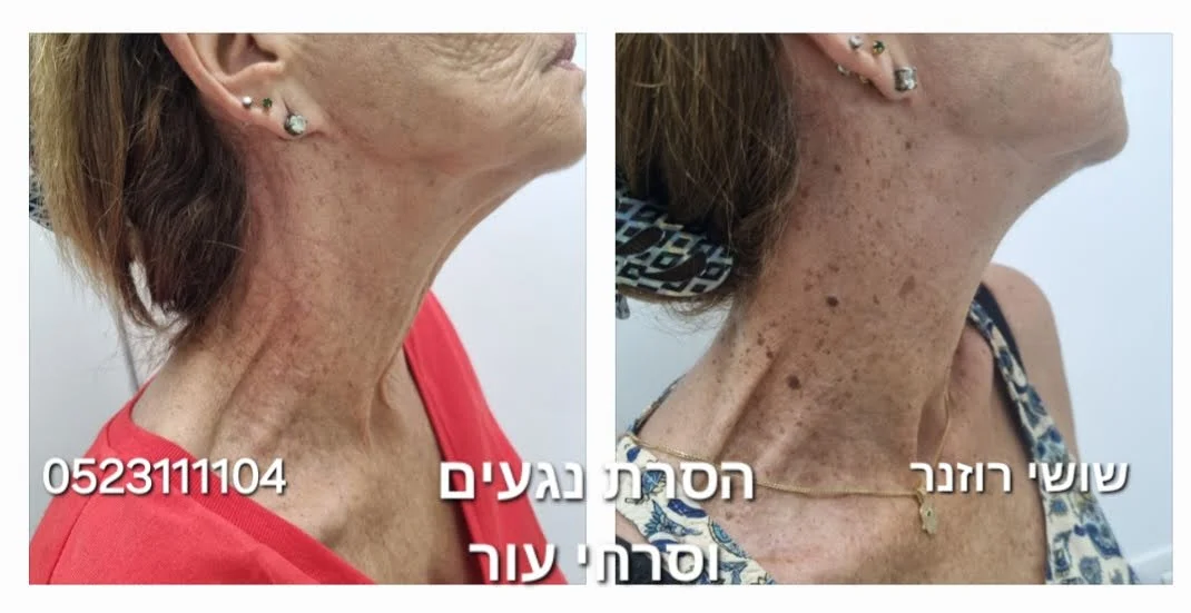 טיפול בשיוף פנים עם לה פונטיין