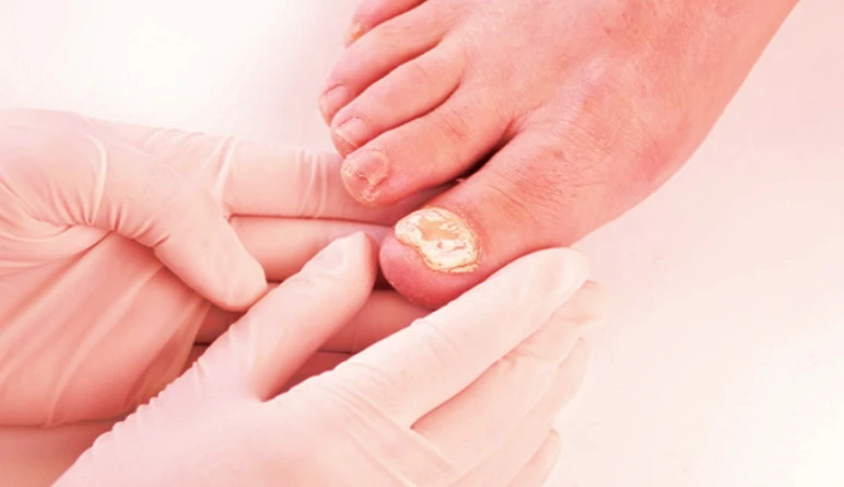 טיפול בפטרת ציפורניים