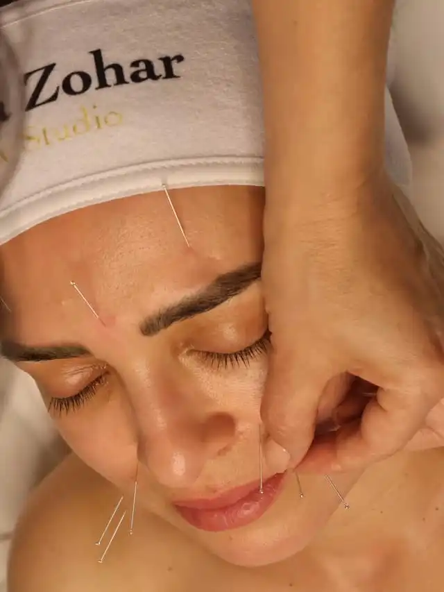 דיקור קוסמטי