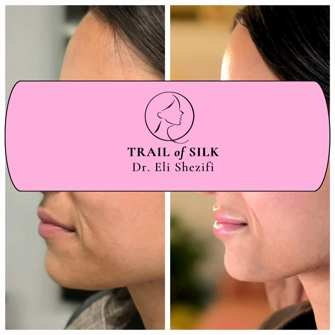 מילוי שפתיים