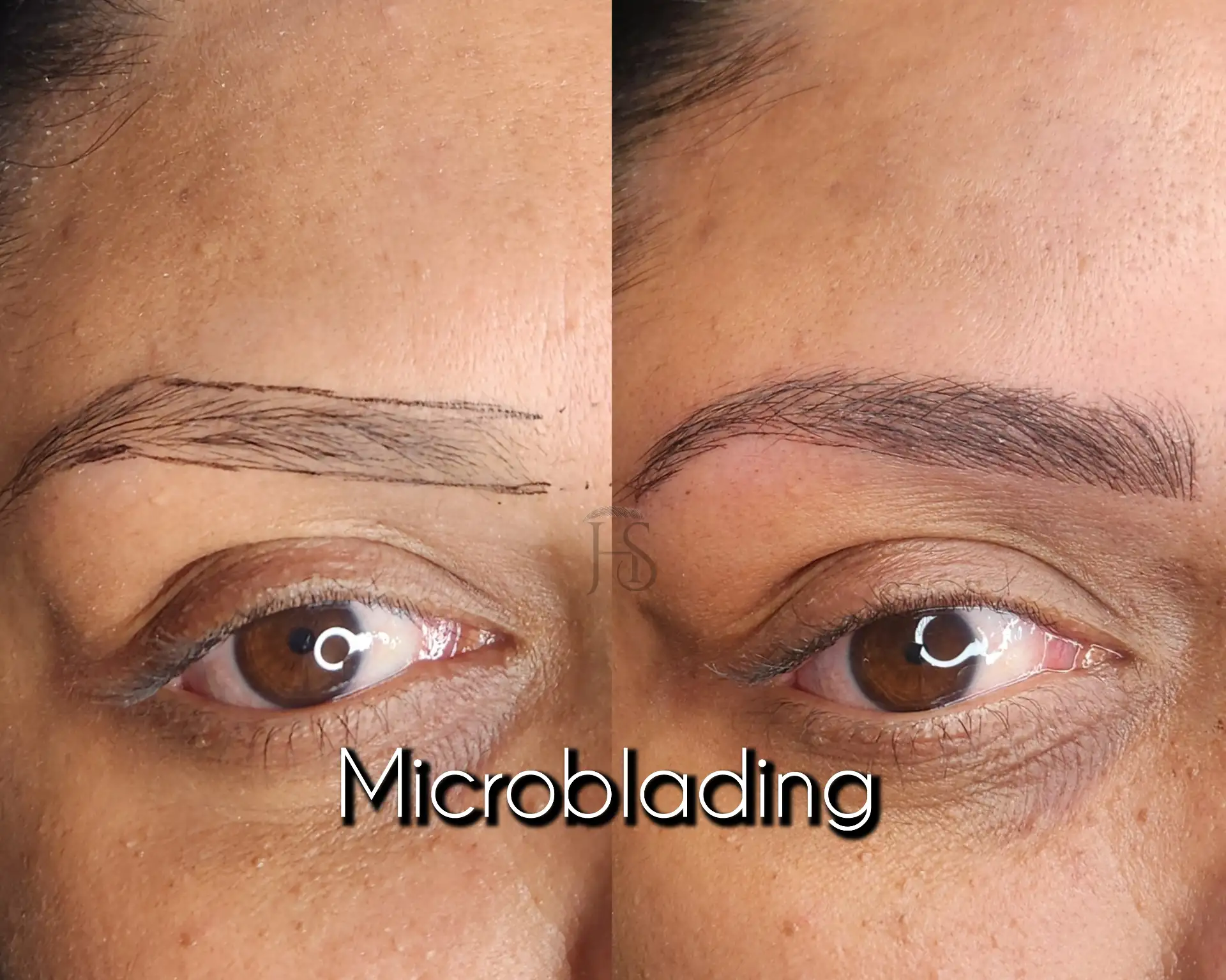 מיקרובליידינג