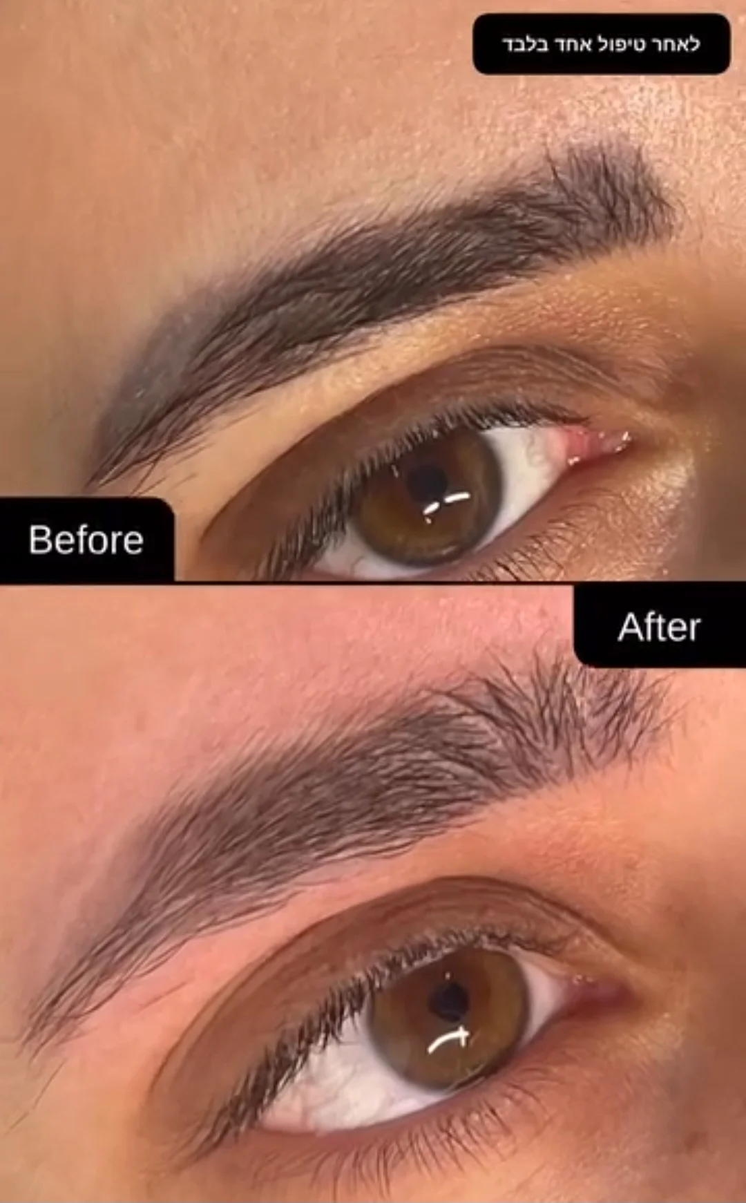 טיפולי לייזר להסרת איפור קבוע בגבות – המדריך המלא