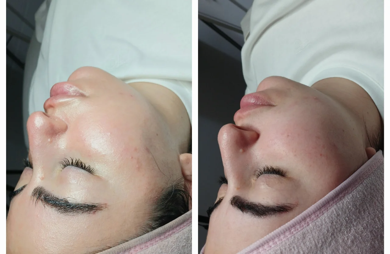 טיפול פנים קלאסי