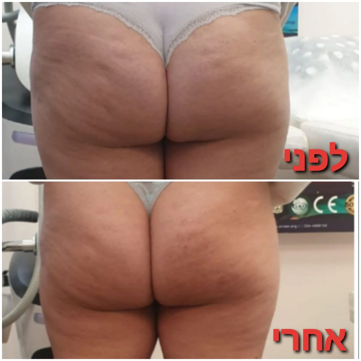 הפחתת צלוליט על ידי מכשיר גלי רדיו RF