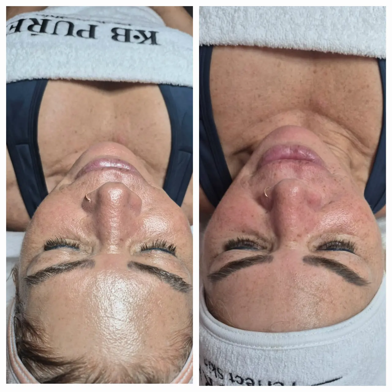 טיפול אייגינג  ומיצוק העור בשיטת RF