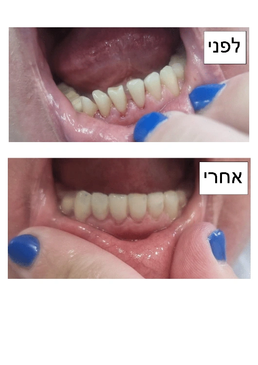 ציפוי חרסינה