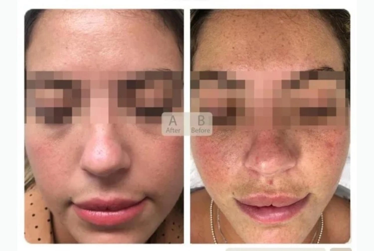Pigmentation treatment - 300$ - 75 min