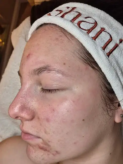 טיפול פנים - אקנה שולב פוטותרפיה