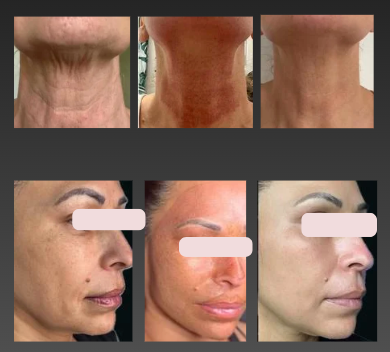 תהליך הטיפול בעט פלזמה 