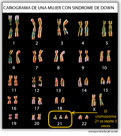 careotipo_mujer_sindrome_down.jpg (400×450)