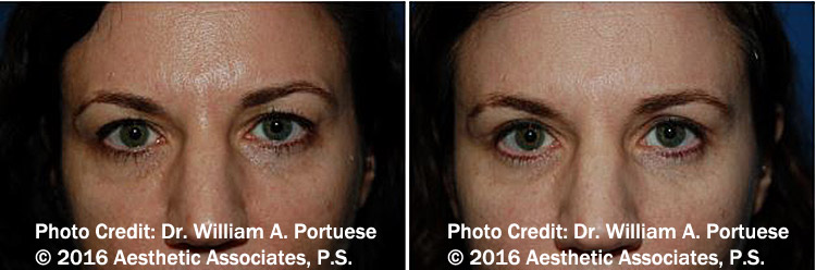 Top Blepharoplasty Surgeon in Portland Oregon