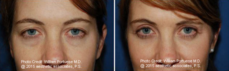 Eyelid Rejuvenation Surgery For Baggy Eyelids