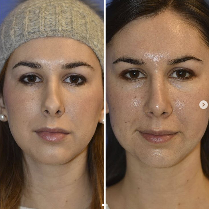 Rhinoplasty in Portland